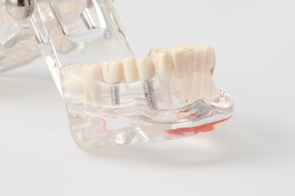 インプラント治療